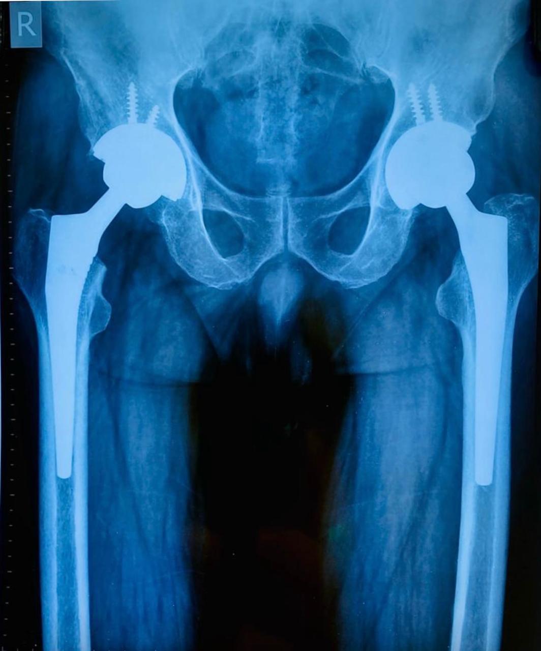 Hip Replacement Surgery: What to Expect Before, During, and After ...